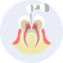 根管治療