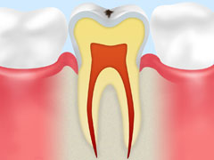 CO　初期のむし歯