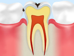 C1　エナメル質のむし歯
