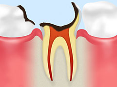 C4　末期のむし歯