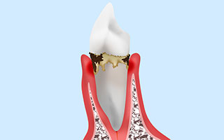 軽度歯周病