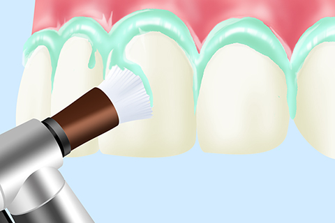 専門的な歯のクリーニング（PMTC）