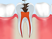 1.歯髄の除去